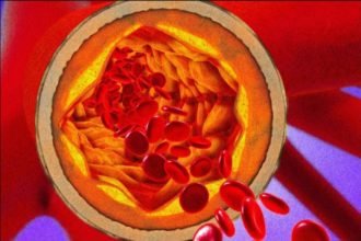 یک بیمار پس از آزمایش ویرایش ژن کلسترول پایین جان خود را از دست داد