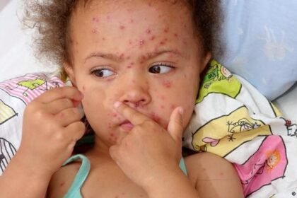 یونیسف: سرخکان در شش ماه گذشته، جان ۳۵۷ کودک افغانستانی را گرفت